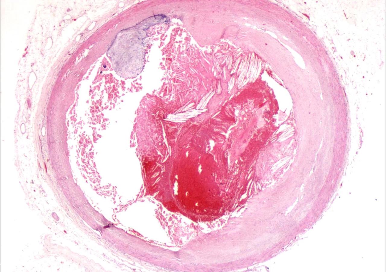 placa vulnerable con trombosis aguda.jpg